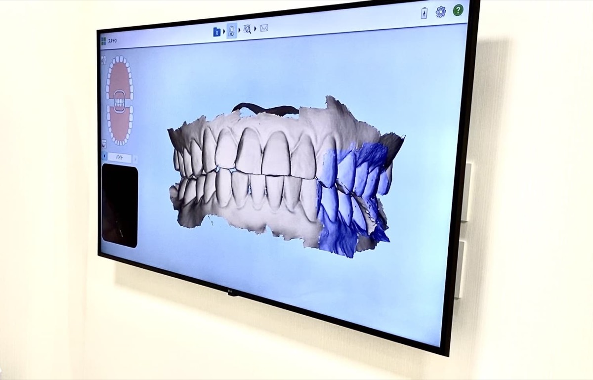 口腔内スキャナーで記録した歯並びの3D画像を映したモニター